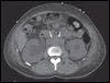 Retroperitoneal Fibrosis