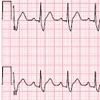 Transient ST Elevations and Conduction Delay After Traumatic Fracture of the Sternum