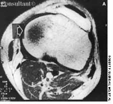 Bone Bruise