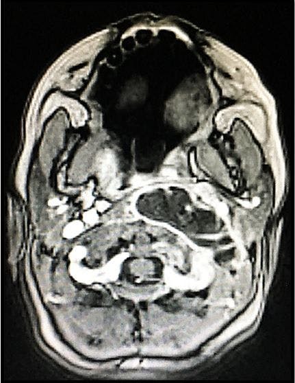 Retropharyngeal abscess 