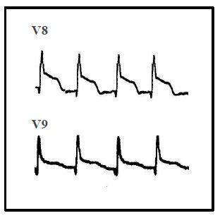 Ischemia or Infarction: What Cause of ACS in a 54-Year-Old Man? 