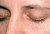 Xanthelasma  49-Year-Old Woman