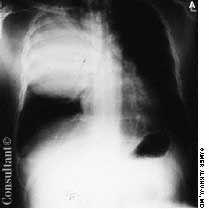 Right Upper Lobe Consolidation Simulating Pulmonary Neoplasm