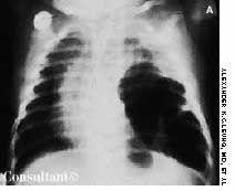 Pneumatoceles