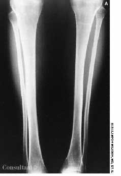 Blue Sclerae in Osteogenesis Imperfecta