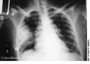 Pneumococcal Pneumonia Presenting as New-Onset Seizure