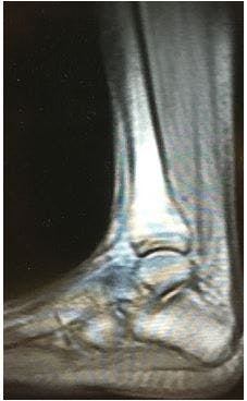 Achilles rupture, quinolones 