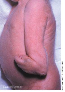 Trisomy 18 (Edwards Syndrome)