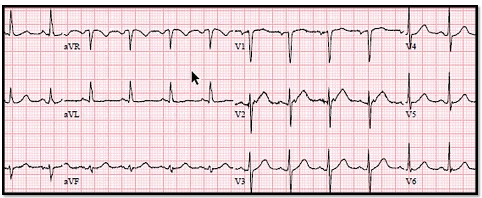 Serial EKGs, STEMI, ACS, acute coronary syndrome