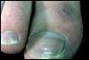 Idiopathic Chilblains