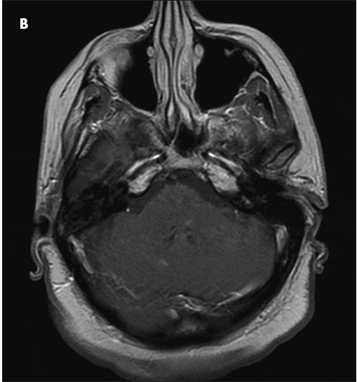 Internuclear Ophthalmoplegia