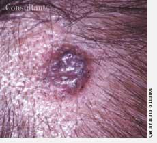 Basal Cell Carcinoma