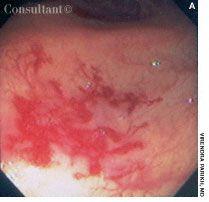 Colonic Arteriovenous Malformations in Man With Family History of Colorectal Cancer