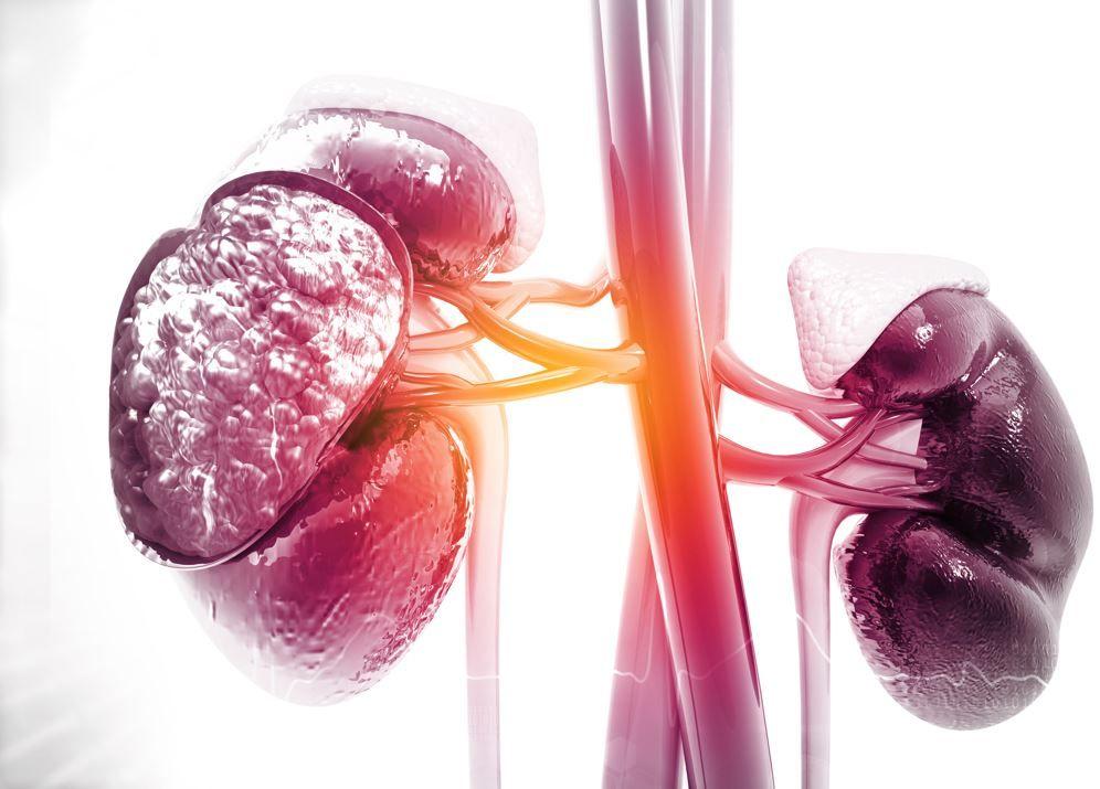 Empagliflozin Reduced Risk of Renal Disease Progression, CV Death Across CKD Spectrum in EMPA-KIDNEY