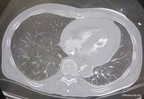 CT examination of chest