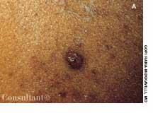 Histoplasmosis