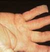 Dupuytren's Contracture