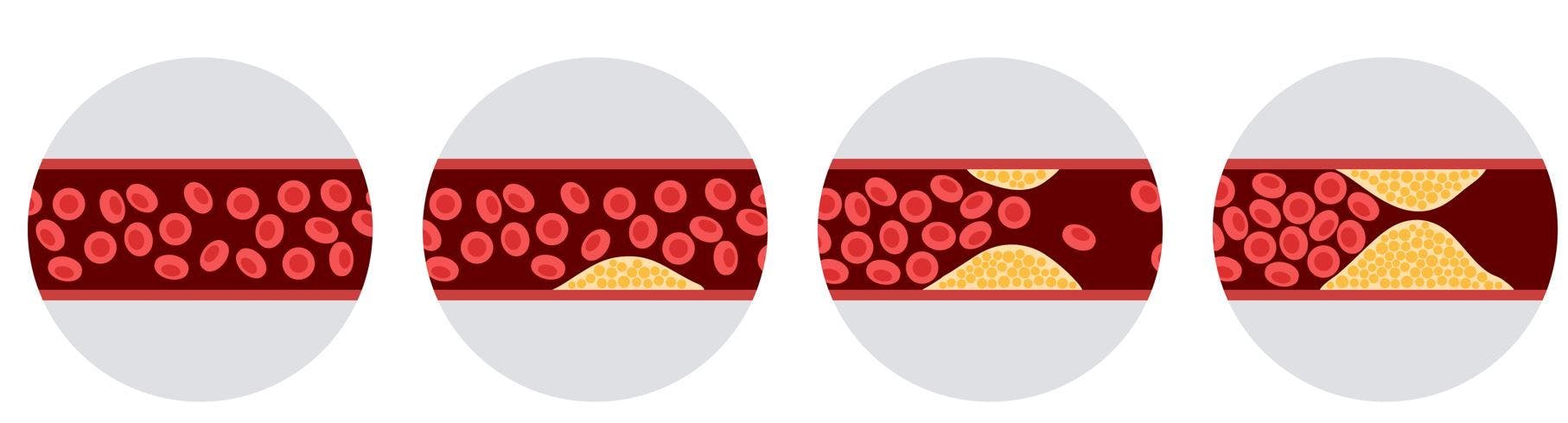 Statins May Reduce Progression of Atherosclerotic Disease in High-risk Patients