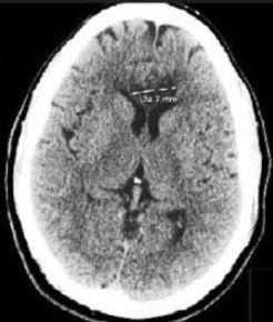 Bilateral Corpus Callosum Stroke