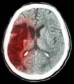 Stroke Risk Spikes After Cancer Dx