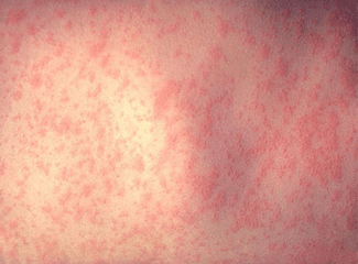 Measles Weasles Its Way Back