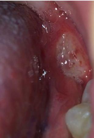 Canker Sore