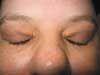 Xanthelasma Palpebrarum