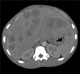 Acute Pancreatitis Secondary to Neuroendocrine Tumor