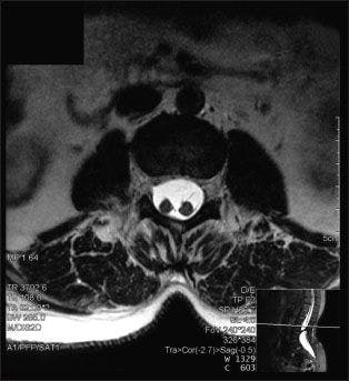 Diastematomyelia