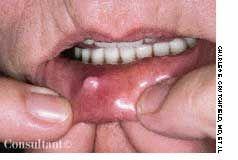 Oral Mucous Cyst