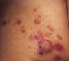 Bullous Impetigo on Buttocks of a 3-Year-Old Girl