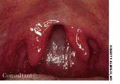 Bifid Uvula