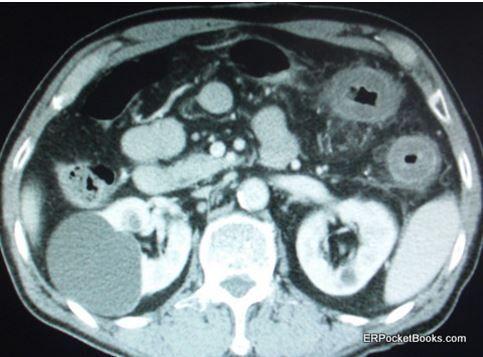 C difficile colitis 