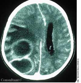 Brain Abscess