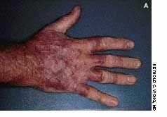 Tinea Manus, Tinea Pedis