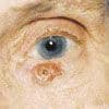 Basal Cell Carcinoma on Lower Eyelid of a 76-Year-Old Woman