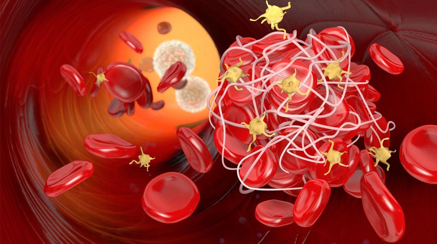 Document Apixaban May Be More Effective vs Warfarin in Patients with VTE Who Need Extended Anticoagulation