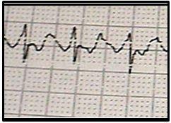 Atrial flutter