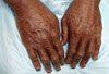 Ichthyosis (“Fish-Scale Skin”)