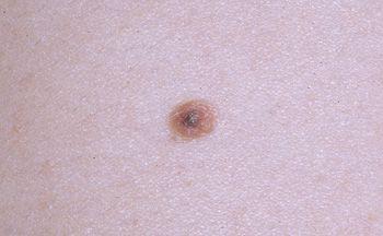 Atypical nevus