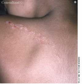 Linear Verrucous Epidermal Nevus