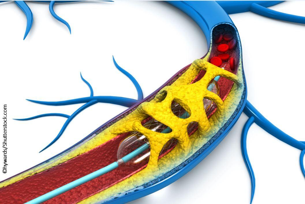 Post-CABG AF: Not So Benign 