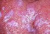 Lichen Planus