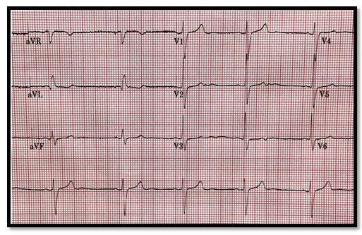 An Elderly Man with Altered Mental Status, Abnormal ECG