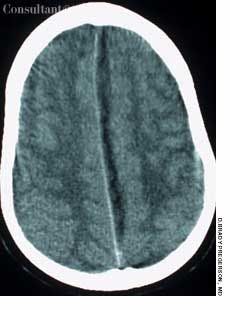 Subdural Empyema Secondary to Sinusitis