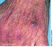 Classic Kaposi's Sarcoma