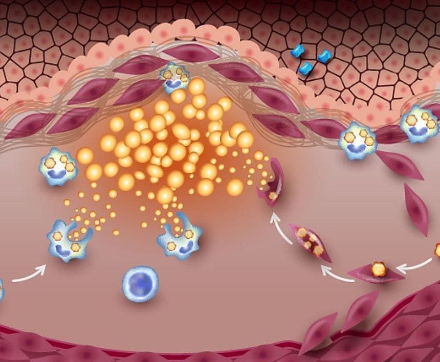 Subclinical Atherosclerosis Risk Linked to A1c Below Prediabetes Threshold 