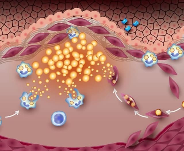 Progression of Subclinical Atherosclerosis Independently Predicts All-Cause Mortality / image credit - plaque: ©Tefi/stock.adobe.com