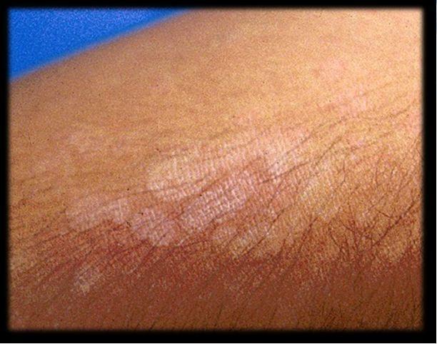 8 Rash Questions About Tinea Versicolor