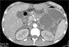 Pseudo-MI in a Patient with Pancreatitis and Polyarteritis Nodosa